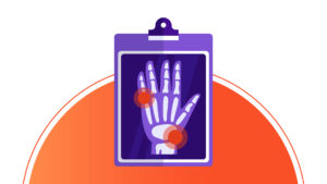 Profesionales del Instituto William Osler analizan estudios para el diagnóstico temprano de la Enfermedad de Gaucher y sus avances en tratamiento.